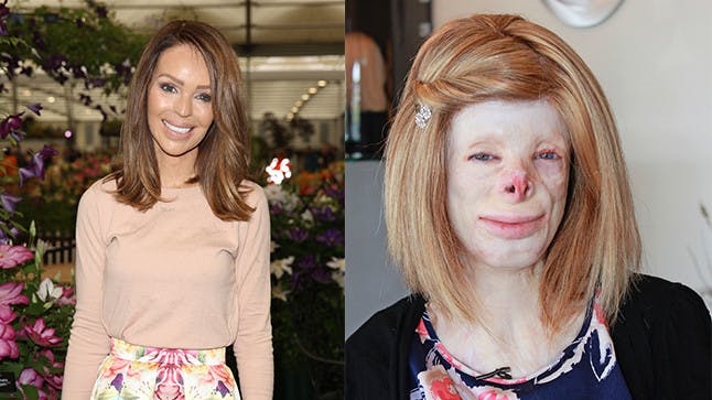 katie piper burn victim        
        <figure class=